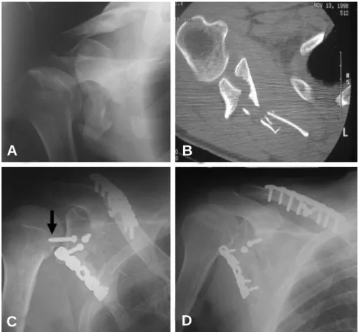 Fig. 4. (A, B) Initial X-ray and CT scan of 72-year-old male show glenoid fracture (modified Ideberg type II), scapu-