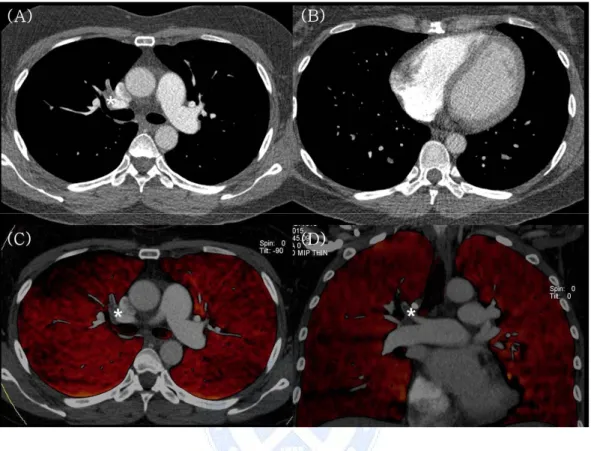 그림 5.  급성 폐색전증으로 진단된 39세 여자 환자의 증례. (A)  우측 상엽폐동맥에서 급성 폐색전증(*)이 관찰된다.  (B)  심실 직경 비가 0.77로 측정되었다