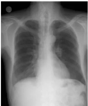 Fig.  3.  Complete  improvement  of  pneumomediastinum  and  subcuta- subcuta-neous  emphysema  in  neck  and  chest.