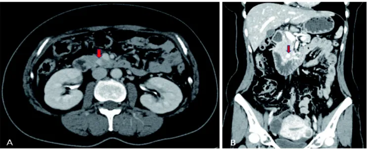 Fig.  1.  Abdominal  computed  tomographic  scan  shows  a  1.1cm sized  contrast  enhanced lesion at  uncinate process  of  pancreas (red arrow)