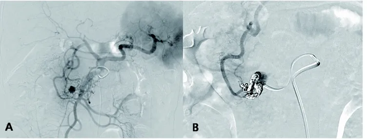 Fig. 3. (A) Angiogram of superior mesenteric artery reveals about 10 x 9 mm sized aneurysm at inferior pancreaticoduodenal artery bifurcation  site. (B) Angiogram after coil embolization shows well occluded anterior and postero-inferior  pancreaticoduodena