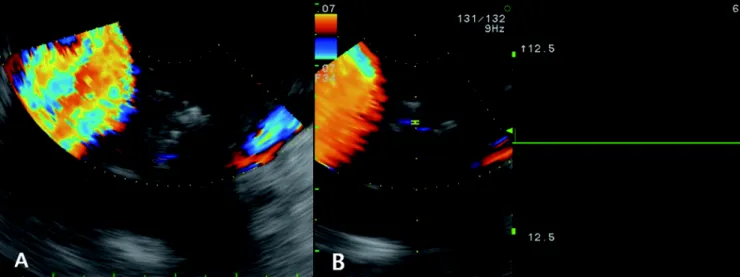 Fig. 4. (A) No turbulent flow is present at the endoscopic ultrasound (A) and pulse wave doppler (B) performed 7 days 복부 석회화 결절이 발견되어 혈관조영술을 시행하여 진단되는 경우가 가장 많았다.12 본 증례는 복부 통증의 감별을 위해 시행한 전산화 단층 촬영상에서 신경 내분비종양과 감별이 어려운 췌장 종괴가 의심되어 내시경초음파를 이용하여 와류를 관찰하여 진단
