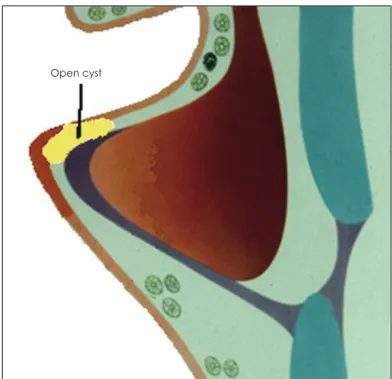 Fig. 7. The schematic feature of open cyst. It has opening to the 
