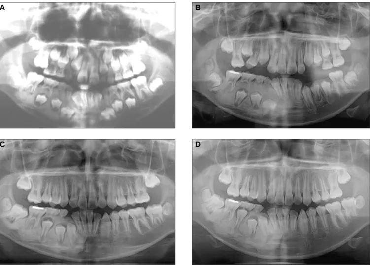 Fig. 2. Delayed eruption of mandibular right lateral dentition and secondary molar. Panoramic view taken at age 7Y 6M(A), 10Y 3M(B), 11Y 6M(C),