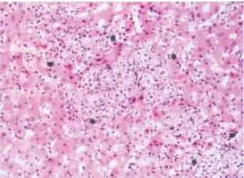 Fig. 1. A microscopic finding of the liver biopsy specimen. This finding shows multifocal ill-defined non-caseating granulomas that consist of loose aggregates of epitheloid cells and lymphocytes (arrows) (H&amp;E stain, ×200).
