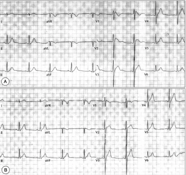 Fig. 4. Changes of ECG findings of a patient with Brugada syndrome(case 3). QRS complex showed incomplete