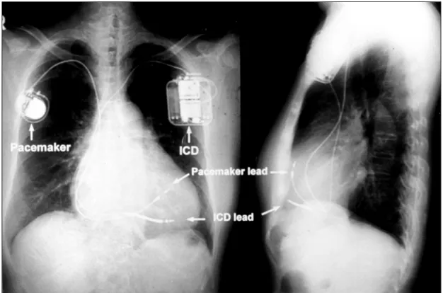 Fig. 7. Implantation of ICD and pacemaker of VVIR type in a patient presented as aborted sudden cardiac dea-