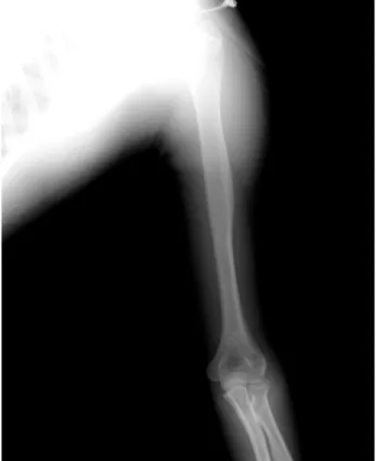 Fig. 1. Radiographs of the upper arm shows soft tissue swelling around left upper arm without fracture.