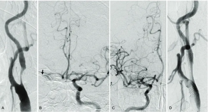 Figure 1. A 67-year-old man presented with left sided weakness. Carotid and cerebral angiography showed severe stenosis of the 