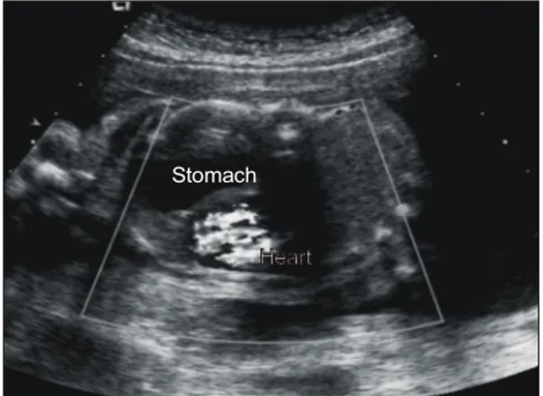 Fig.  1.  Fetal  sonogram  (gestational  age  29  weeks)  of  patient  1  shows  4-chamber  of  heart  surrounded  by  stomach  at  chest  level  but  can  not  show  the   hypere-choic,  thin  diaphragmatic  membrane.