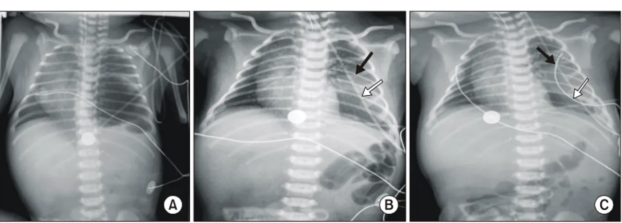 Fig.  2.  Images  of  patient  1.  On  the  chest  radiography  obtained  50  minutes  after  birth  shows  shifting  of  the  mediastinum  to  the  right  with  a  linear  and  smooth  margined  radiolucent  leaf  (A)