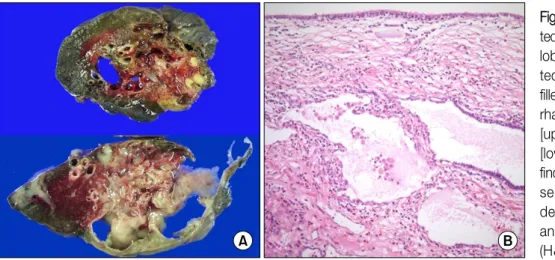 Figure  3.    (A)  Gross  resec- resec-ted specimen of both lower lobe  showed   multisepta-ted  cystic  masses  which  filled  with  pus  and   hemor-rhage  (right  lower  lobe  [upper]  &amp;  left  lower  lobe  [lower])