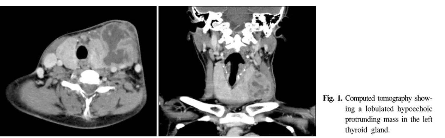 Fig.  1.  Computed  tomography  show-