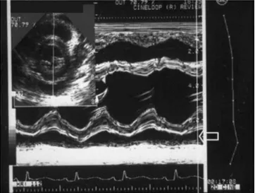 Fig. 4. A Echocardiogram shows a pericardial effusion in a patient with systemic-onset JRA.