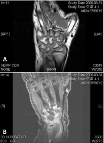 Fig. 6. MRI findings of left wrist in polyarticular JRA patient. Extensive synovial enhancement in radiocarpal, intercarpal, and carpometacarpal joint are shown