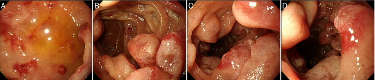 Fig. 1. Esophagogastroduodenoscopic finding. (A) Numerous reddish, erosive lesions at duodenal bulb