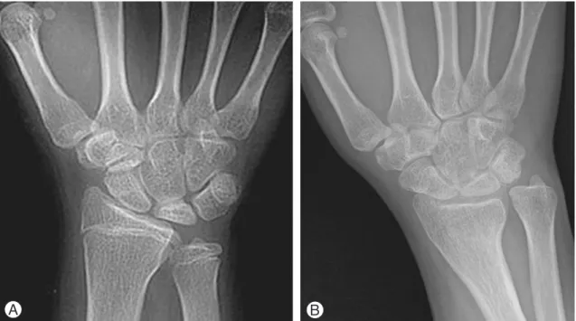Fig. 2. Lichtman stage IIIA (Case 1, 12/F, duration: 6 mos., hardware removal at postop