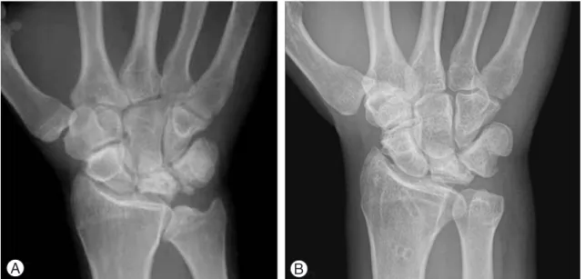Fig. 3. Lichtman stage IIIA (Case 5, 27/M, duration: 7 yrs., hardware removal at postop