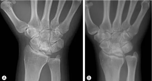 Fig. 5. Lichtman stage IIIB (Case6, 35/F, duration: 8yrs., hardware removal at postop