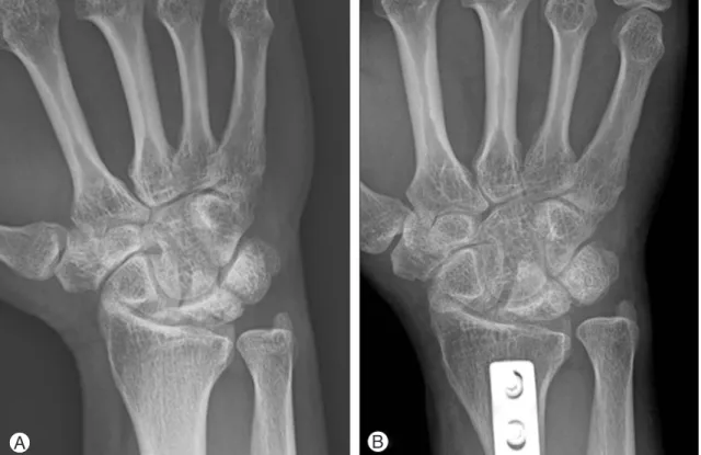 Fig. 7. Lichtman stage IIIB (Case 11, 29/M, duration: 1 yrs. 2 mos., +1 mm positive ulnar variance) (A) Preop