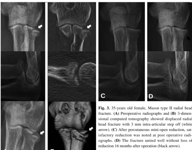 Fig. 3. 35-years old female, Mason type II radial head