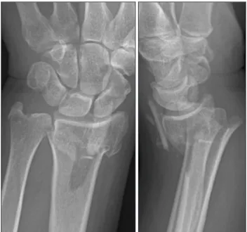 Fig.	1.  Fifty six years female patient with distal radius frac-