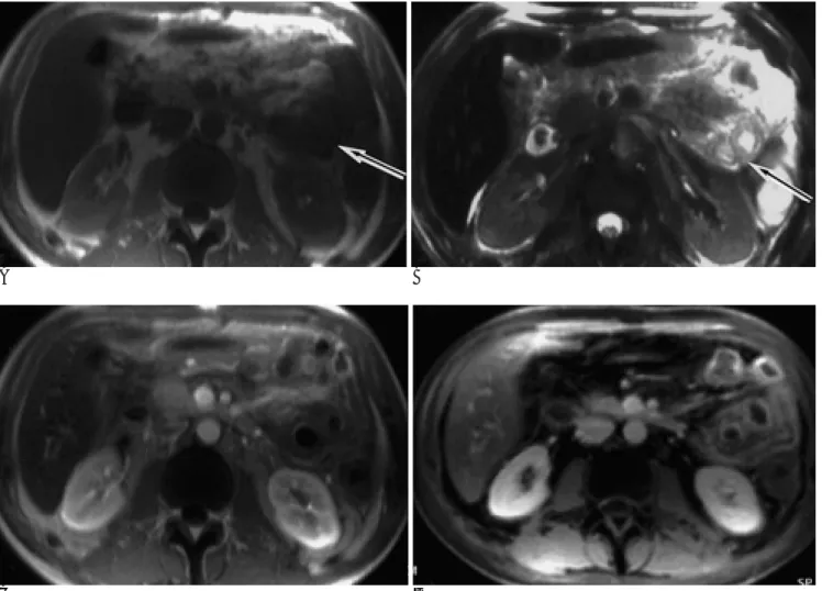 Fig. 1. A 50-year-old woman with acute myelocytic leukemia. On precontrast T1-weighted SGE (A) and T2-weighted HASTE (B) images, jejunal loops (arrow) showed diffuse wall thickening with adjacent localized ascites