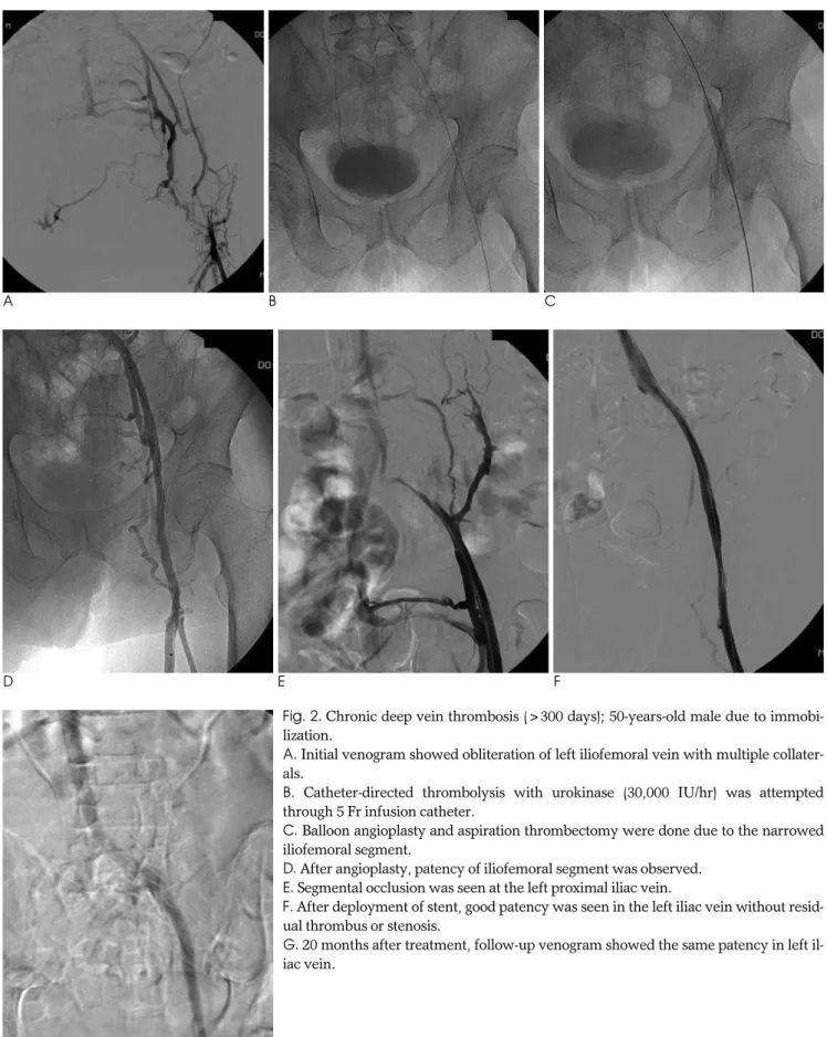 Fig. 2. Chronic deep vein thrombosis (>300 days); 50-years-old male due to immobi-