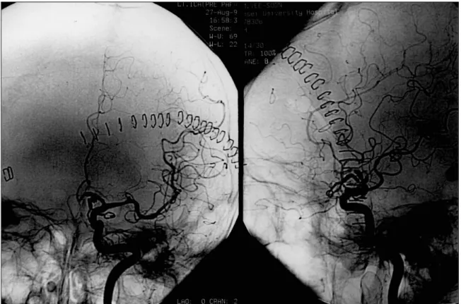 Fig. 2. Postoperative angiogram of the left ICA obtained during the early arterial phase showing complete obliteration of aneurysms  and patent distal left A2 segment