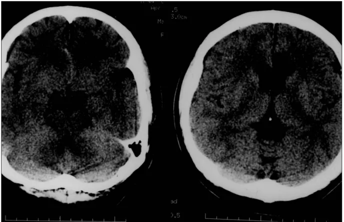 Fig. 3. Axial noncontrast-enhanced CT scan revealing subadventitial hemorrhage and focal low density on the left cingulate gyrus
