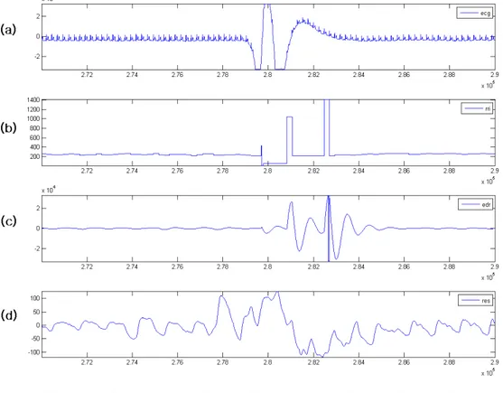 그림 5.10는  피험자 A에 대한  186분의  수면 동안 측정된  신호이다. 그림 5.11은  그림 5.10에서  15~16분  사이의  신호로  움직임으로  인해  기저선  움직임이  크게  있 은  후 QRS 검출을 다시 진행한 것이다