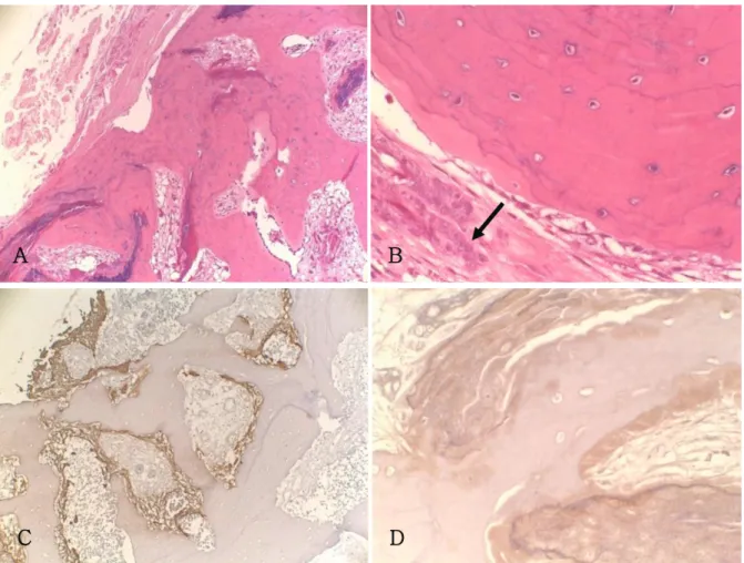 Fig.  2.  A. Microscopic features of the lesion demonstrate mature cancellous bone surrounded by epithelial cells