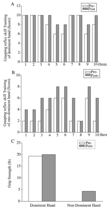 Figure 2. Effect of Grasping Reflex Skill and Grip  Strength in Case 2. (A) Dominent hand (B) Non-dominent hand (C) Grip Strength