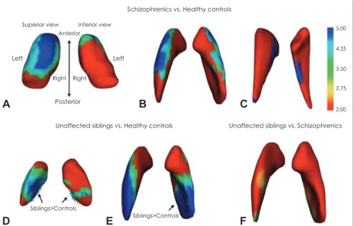 Fig. 1. Significant shape differences between different subject groups. For the SZ versus HC comparison, there are green-to-blue shading  which denotes regions of inward deformation compared with healthy controls without affected sibling in the anterolater