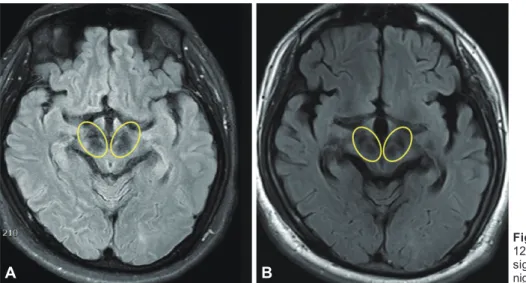 Fig. 1. T2 flair image MRI, 2014/ 