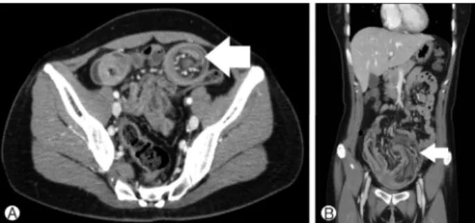 Fig. 2. Abdominal computed tomography findings. Three months later, previously identified small bowel intussusceptions in the ileum was worsened (arrows).