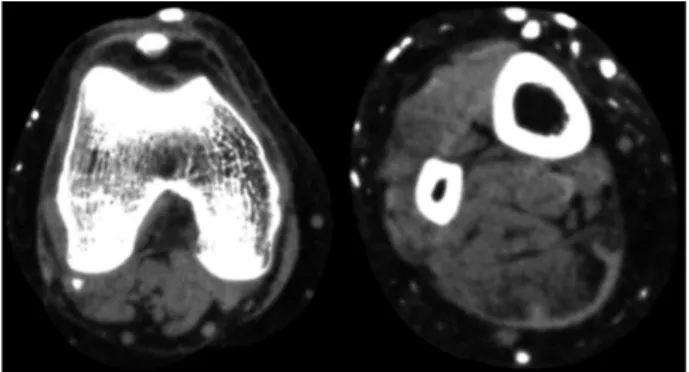 Fig. 5. On right tibial computed tomography, multiple small  calcifications were observed in the subcutaneous fat layer.
