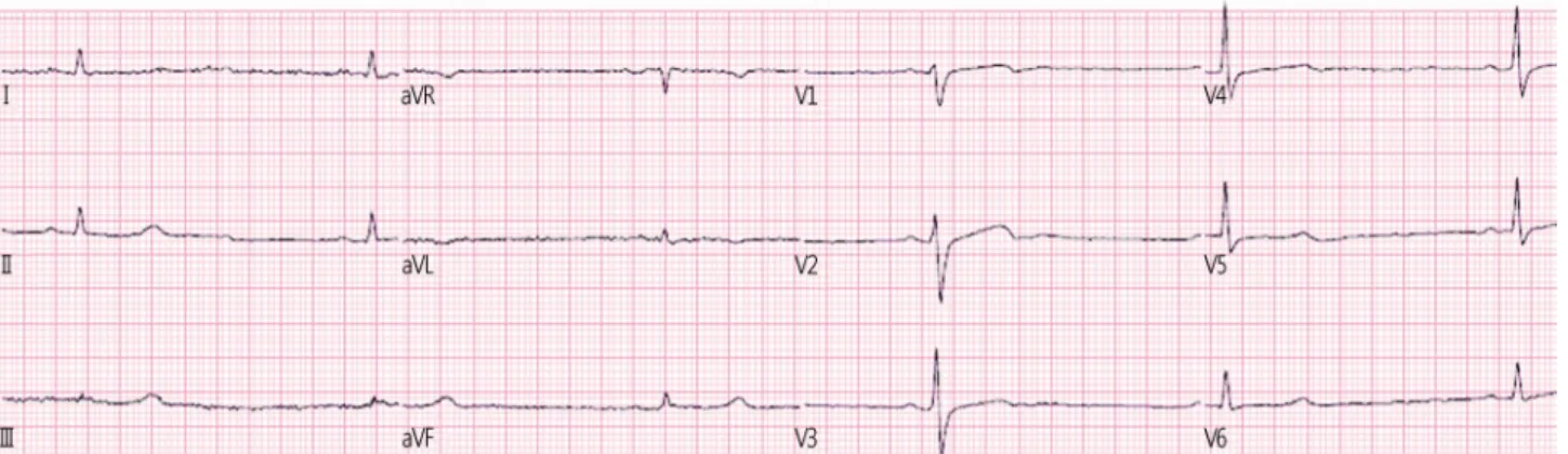 Fig. 2. Electrocardiography on arrival, showed marked sinus bradycardia (30 beats per minute).