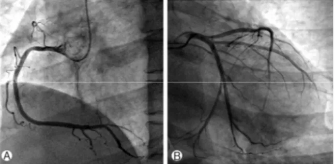 Fig. 4. Coronary angiography. (A) right coronary artery, (B) left circumflex artery and left anterior descending artery.