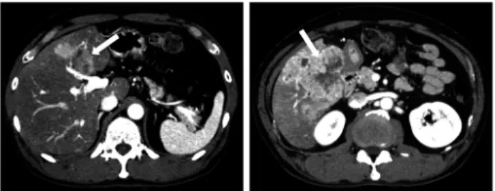 Fig. 1. Abdominal computed tomography shows multiple hepato- hepato-cellular carcinomas in the entire liver with extensive involvement of segment 5.