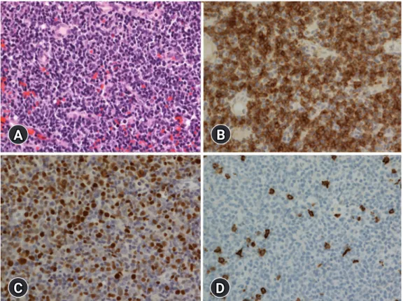 Fig. 1. Histologic and immunohistochemical findings. (A) Diffuse infiltration of small-to-medium–sized lymphoid cells is observed  (hematoxylin and eosin stain, ×400)