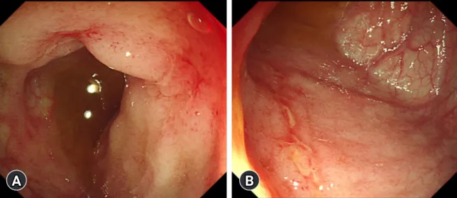 Fig. 2. Images at the diagnosis of Crohn disease. (A) Upper gastrointestinal endoscopy shows multiple ulcers in the duodenum
