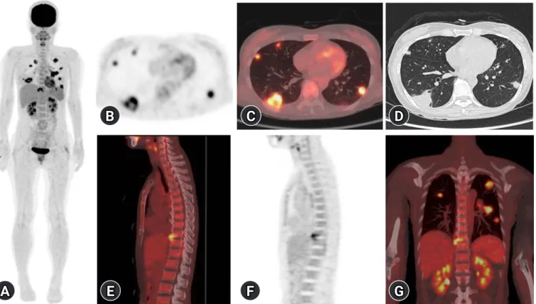 Fig. 2. (A) Extracardiac metastatic infection in a 51-year-old woman demonstrating bilateral lung infection and spondylodiscitis  resulting from Staphylococcus aureus