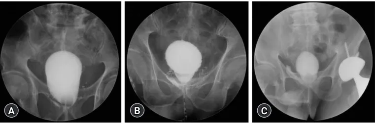 Fig. 1.  Cystography findings and classification of urinary leakage (UL). (A) Mild UL (UL developed after bladder filling with 200 mL normal  saline)
