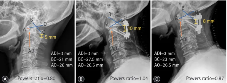 Fig. 1. Pre- and postoperative cervical spine lateral plain radiography. (A) Preoperative, (B) 1st postoperative, and (C) after 2nd  postoperative images