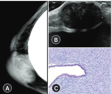 Fig. 1. Radiologic and pathologic findings of recurrent malignant  phyllodes tumor of the breast in a 48-year-old woman