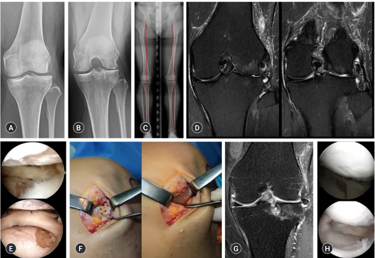 Fig. 3.  (A, B) Kellgren-Lawrence grade III osteoarthritis is observed in the left knee anteroposterior and 45° flexion standing radiographs  in a 49-year-old woman