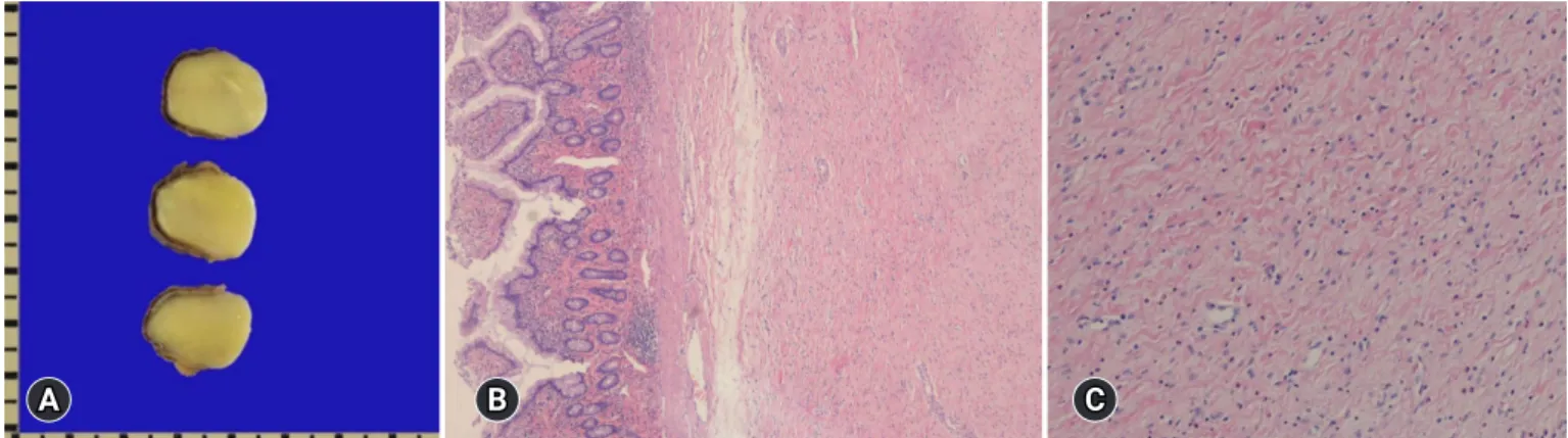 Fig. 4. Gross and microscopic findings of Meckel's diverticulum. (A) Meckel’s diverticulum with an outpouching, closed luminal structure is  present in the distal ileum