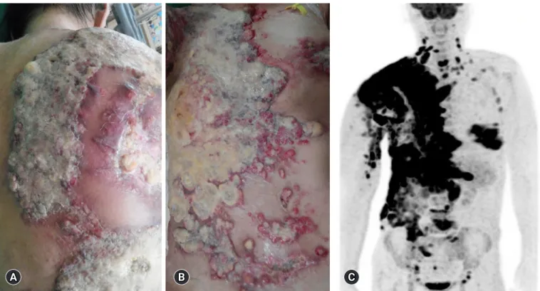 Fig. 1. Heavily pretreated breast cancer with widespread skin metastases on July 2017