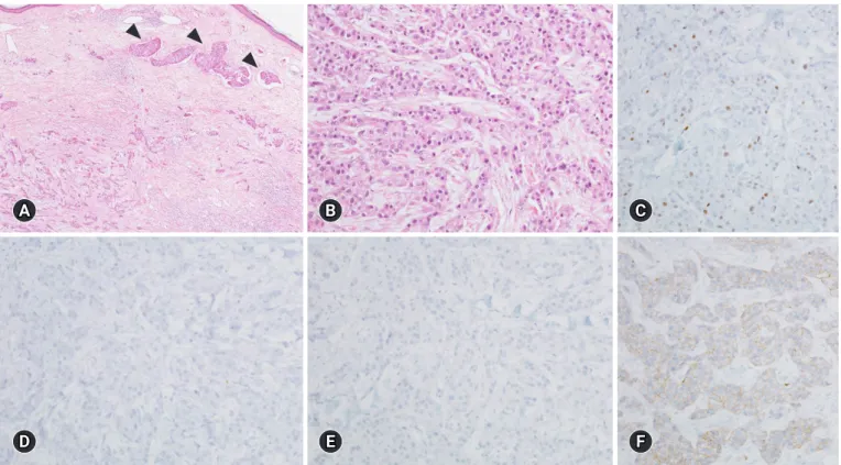 Fig. 2. Representative histological features and immunohistochemical (IHC) findings of the metastatic carcinoma